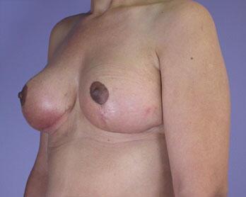 Breast Reduction (for Women) Before & After Image