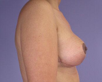 Breast Reduction (for Women) Before & After Image