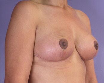 Breast Reduction (for Women) Before & After Image