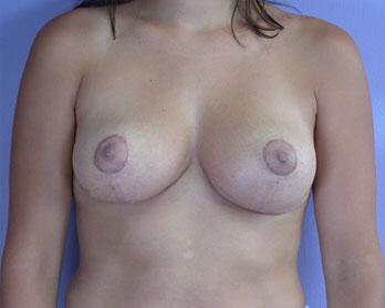 Breast Reduction (for Women) Before & After Image