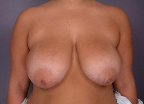 Breast Reduction (for Women) Before & After Image