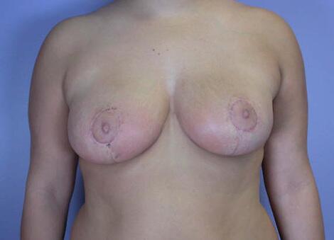 Breast Reduction (for Women) Before & After Image