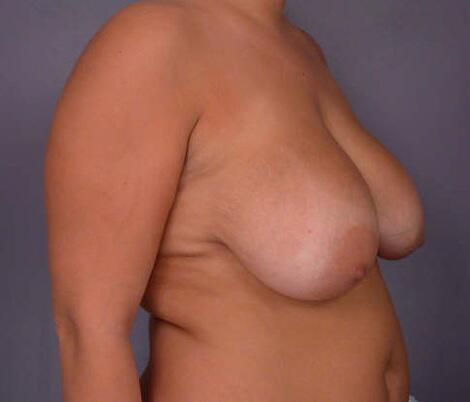 Breast Reduction (for Women) Before & After Image