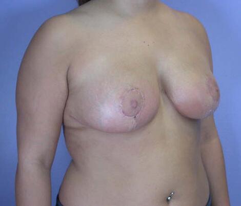 Breast Reduction (for Women) Before & After Image