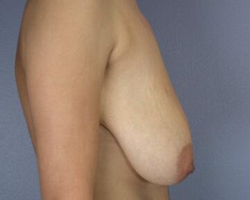 Breast Reduction (for Women) Before & After Image