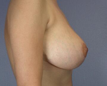 Breast Reduction (for Women) Before & After Image