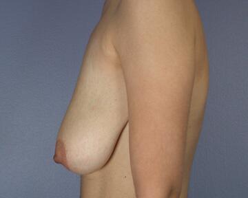 Breast Reduction (for Women) Before & After Image