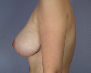 Breast Reduction (for Women) Before & After Image