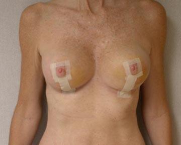 Breast Reduction (for Women) Before & After Image