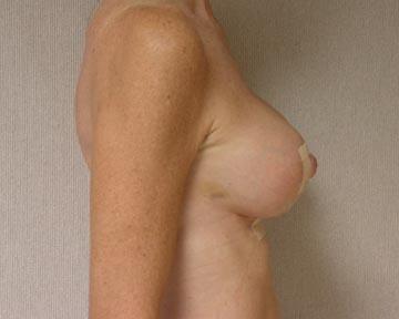 Breast Reduction (for Women) Before & After Image