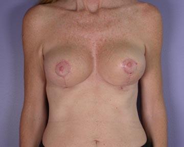 Breast Reduction (for Women) Before & After Image