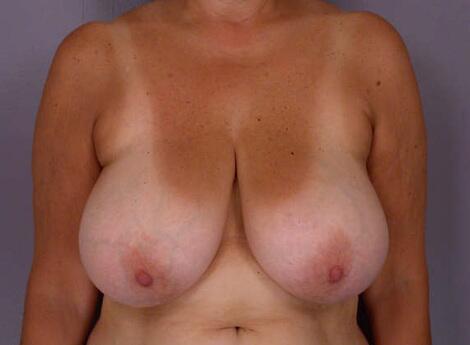 Breast Reduction (for Women) Before & After Image