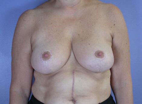 Breast Reduction (for Women) Before & After Image