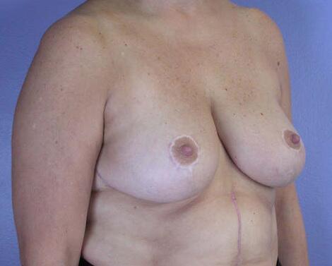 Breast Reduction (for Women) Before & After Image