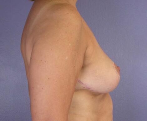 Breast Reduction (for Women) Before & After Image