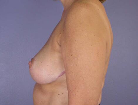 Breast Reduction (for Women) Before & After Image