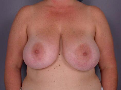 Breast Reduction (for Women) Before & After Image