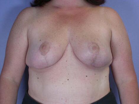 Breast Reduction (for Women) Before & After Image