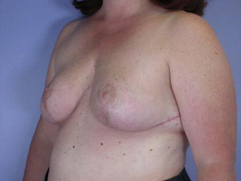 Breast Reduction (for Women) Before & After Image