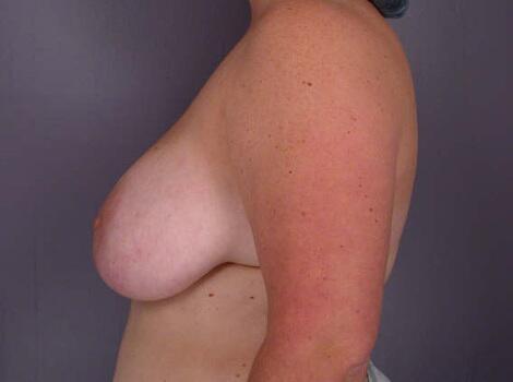 Breast Reduction (for Women) Before & After Image