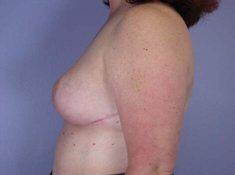 Breast Reduction (for Women) Before & After Image