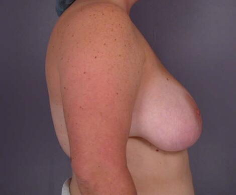 Breast Reduction (for Women) Before & After Image