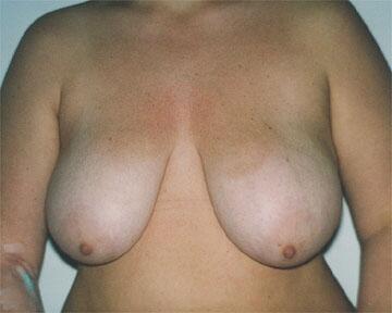 Breast Reduction (for Women) Before & After Image