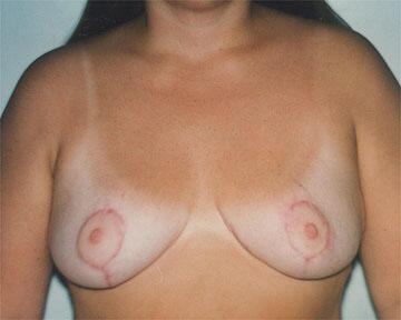 Breast Reduction (for Women) Before & After Image