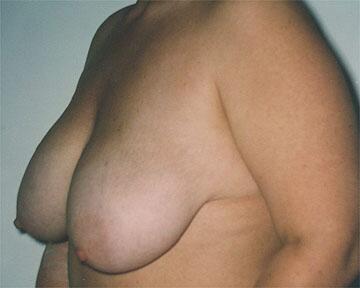 Breast Reduction (for Women) Before & After Image