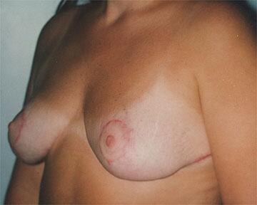 Breast Reduction (for Women) Before & After Image