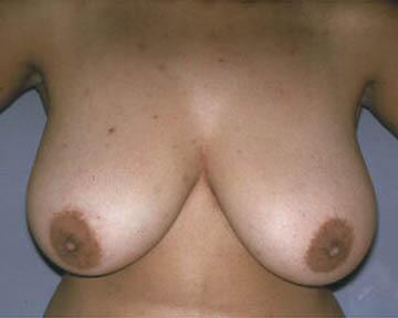 Breast Reduction (for Women) Before & After Image