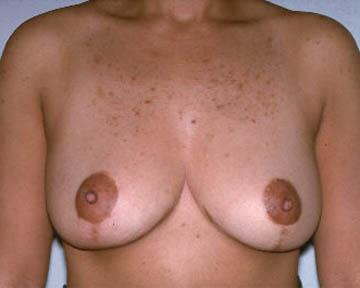 Breast Reduction (for Women) Before & After Image