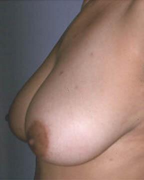 Breast Reduction (for Women) Before & After Image