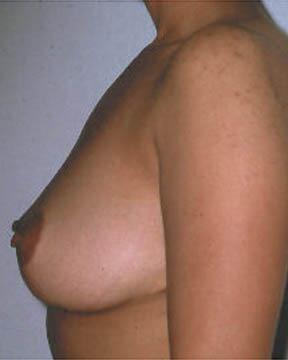 Breast Reduction (for Women) Before & After Image