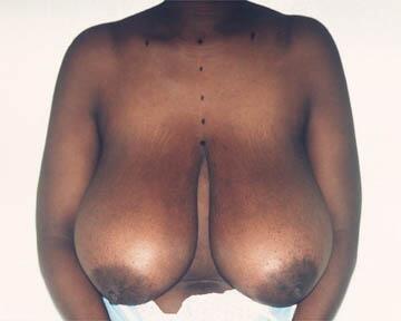 Breast Reduction (for Women) Before & After Image