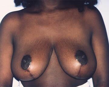 Breast Reduction (for Women) Before & After Image