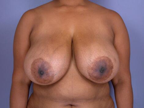 Breast Reduction (for Women) Before & After Image