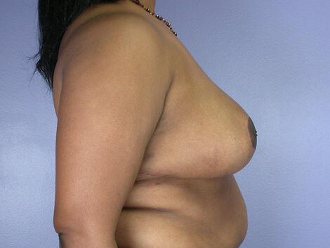 Breast Reduction (for Women) Before & After Image