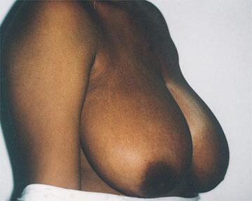 Breast Reduction (for Women) Before & After Image