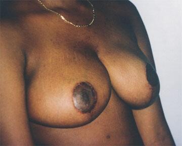 Breast Reduction (for Women) Before & After Image