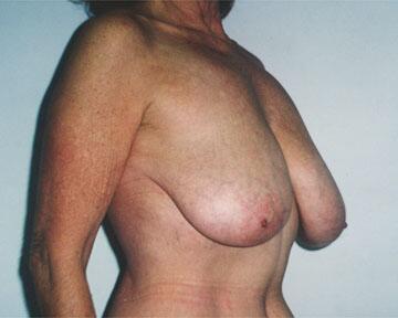 Breast Reduction (for Women) Before & After Image