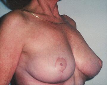 Breast Reduction (for Women) Before & After Image