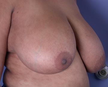 Breast Reduction (for Women) Before & After Image