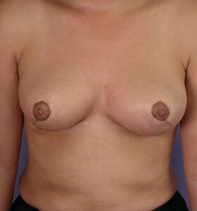 Breast Reduction (for Women) Before & After Image