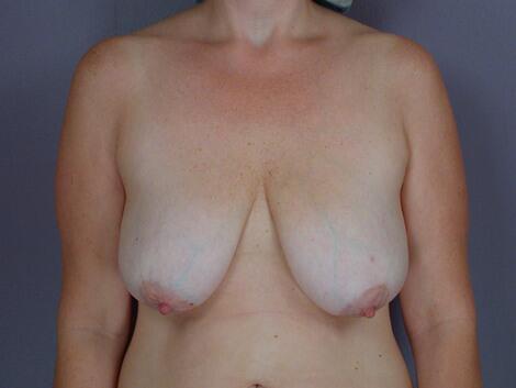 Breast Reduction (for Women) Before & After Image