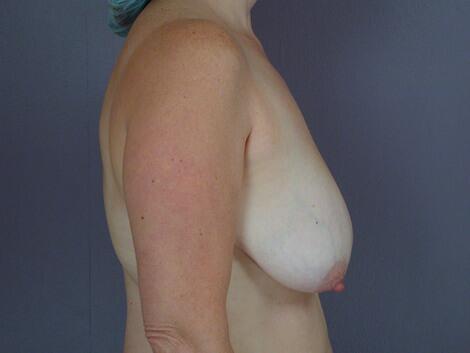 Breast Reduction (for Women) Before & After Image