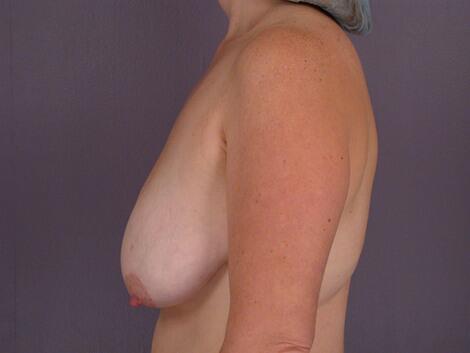 Breast Reduction (for Women) Before & After Image