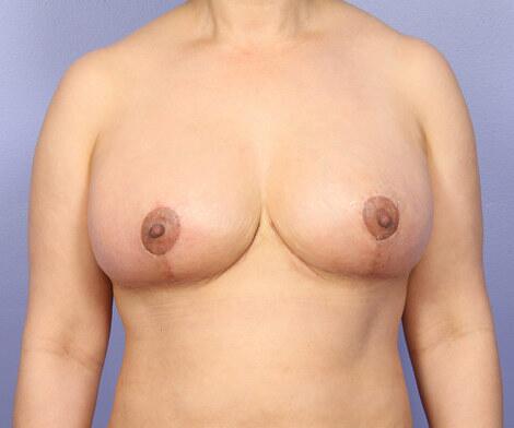 Breast Reduction (for Women) Before & After Image