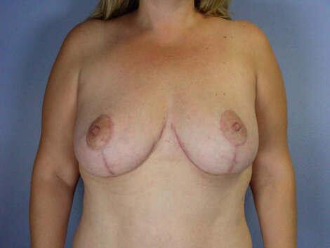 Breast Reduction (for Women) Before & After Image