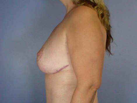 Breast Reduction (for Women) Before & After Image